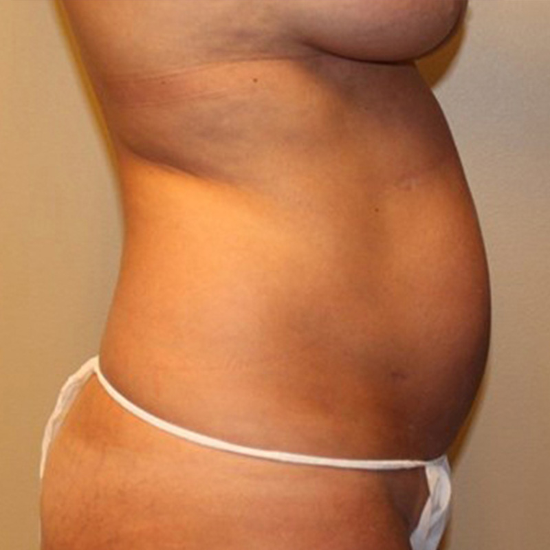 Mini Abdominoplasty 05