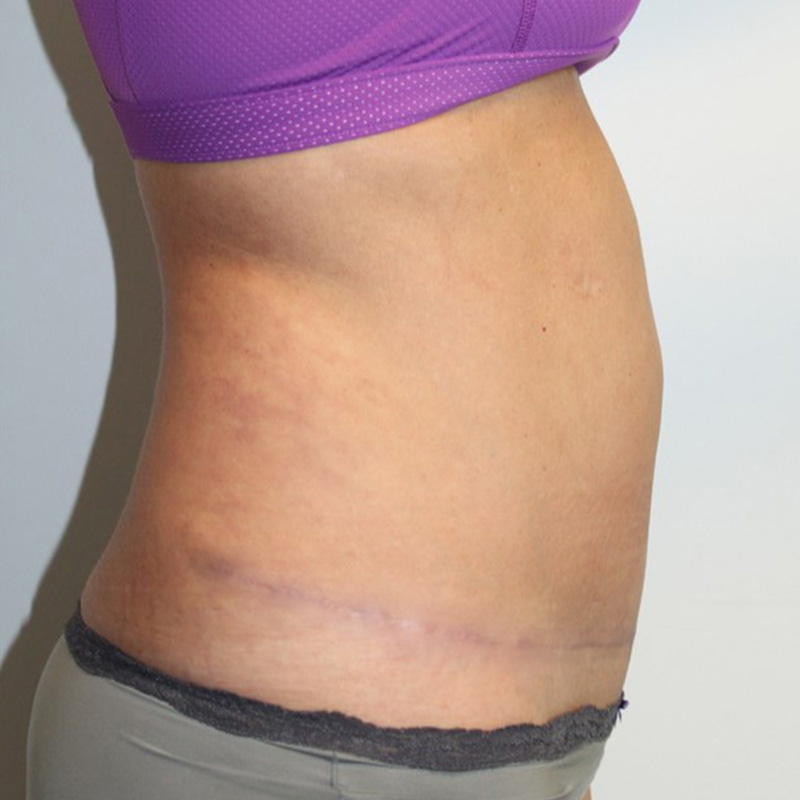 Mini Abdominoplasty 05
