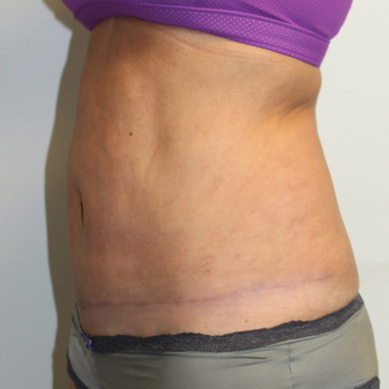 Mini Abdominoplasty 07