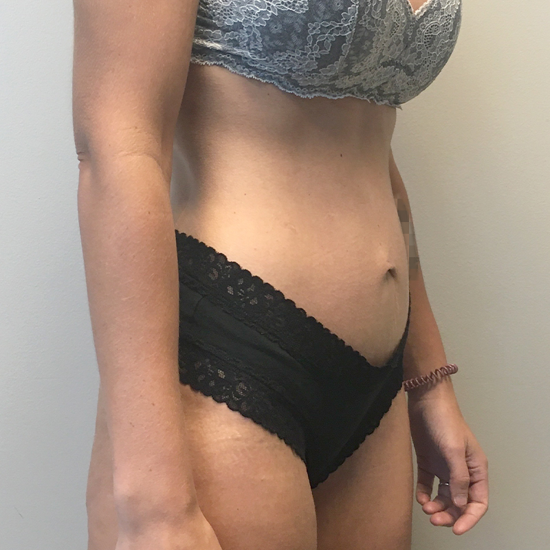 Mini Abdominoplasty 04