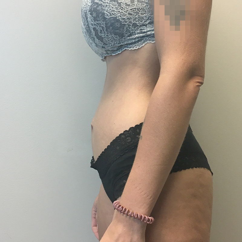 Mini Abdominoplasty 05