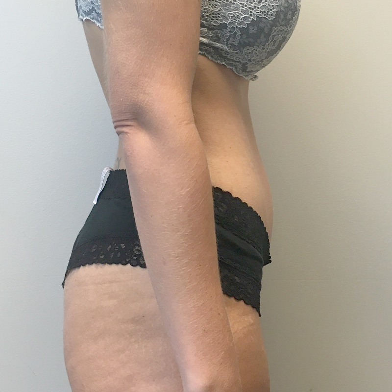 Mini Abdominoplasty 07