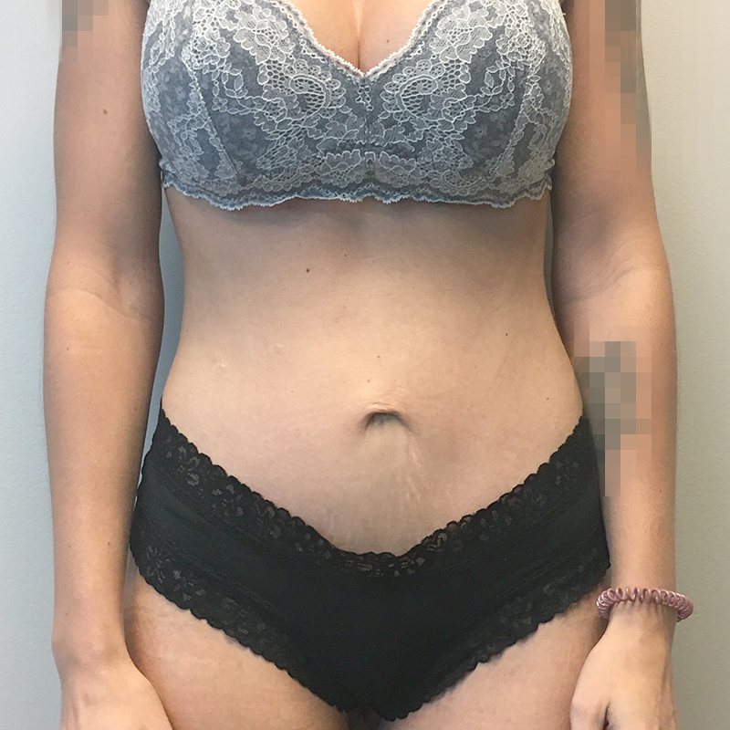 Mini Abdominoplasty 09