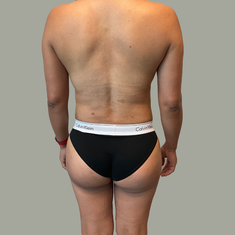 Mtf Body Contouring 03