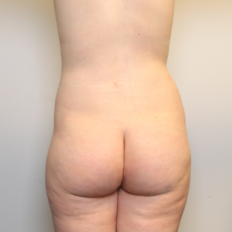 Mtf Body Contouring 02