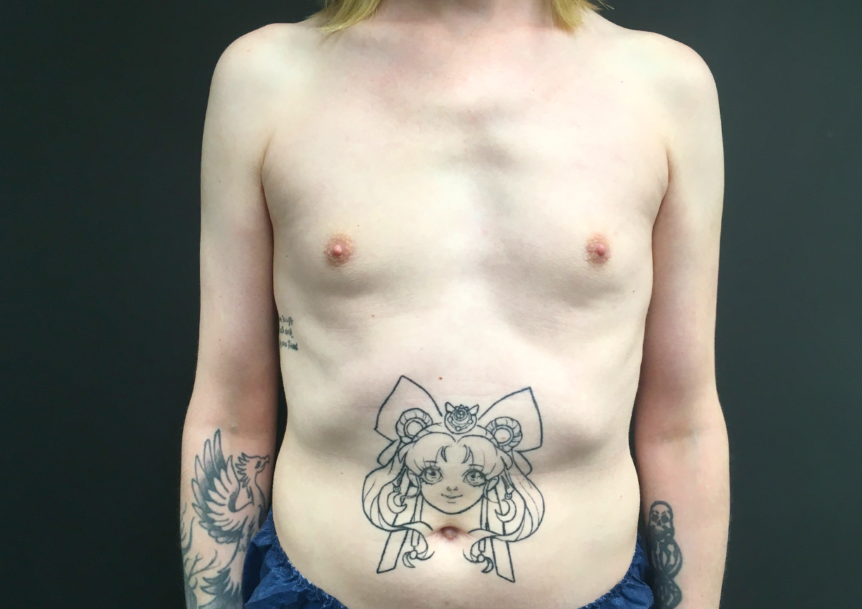 Mtf Breast Augmentation 01