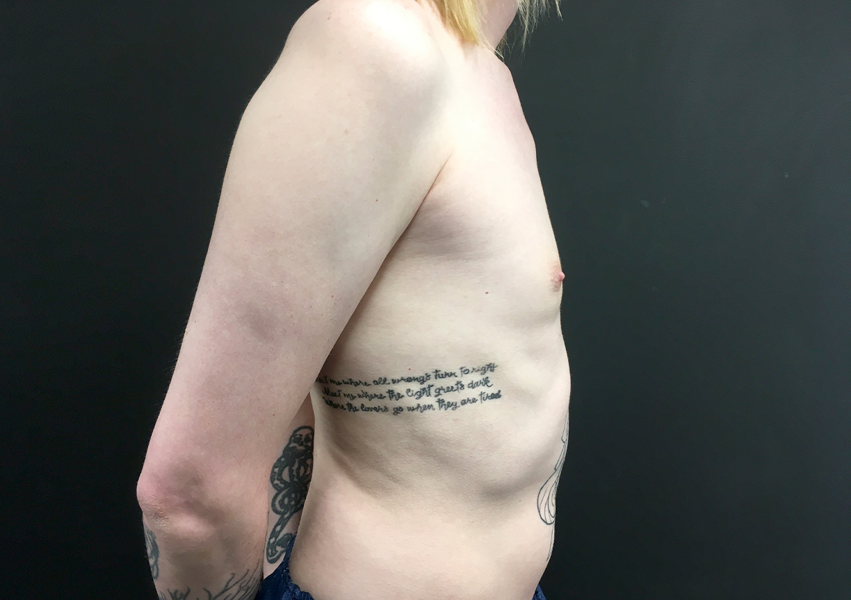 Mtf Breast Augmentation 05