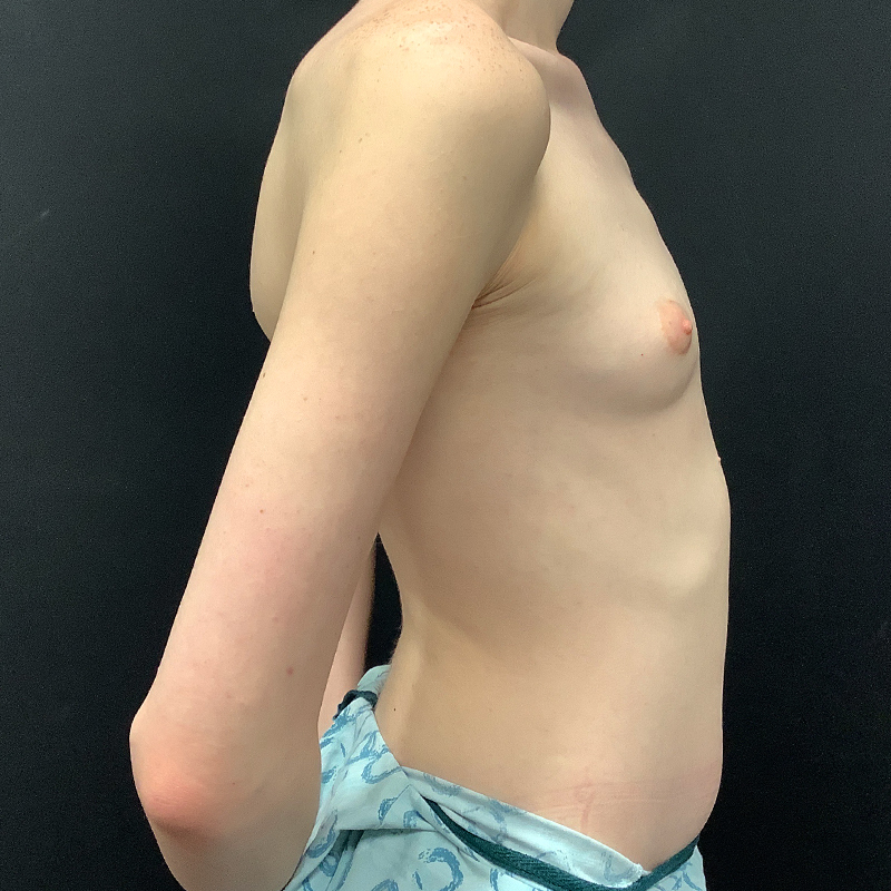 Mtf Breast Augmentation 05