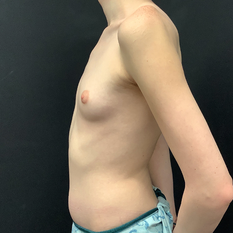 Mtf Breast Augmentation 09