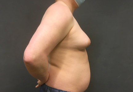 Mtf Breast Augmentation 01