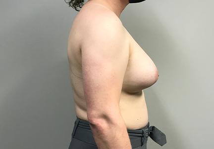 Mtf Breast Augmentation 03