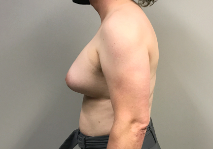 Mtf Breast Augmentation 07