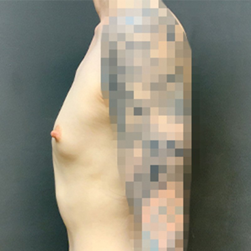 Mtf Breast Augmentation 09