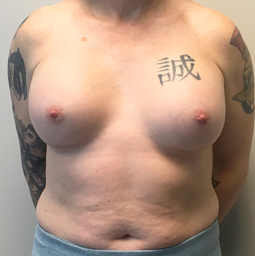 Mtf Breast Augmentation 06