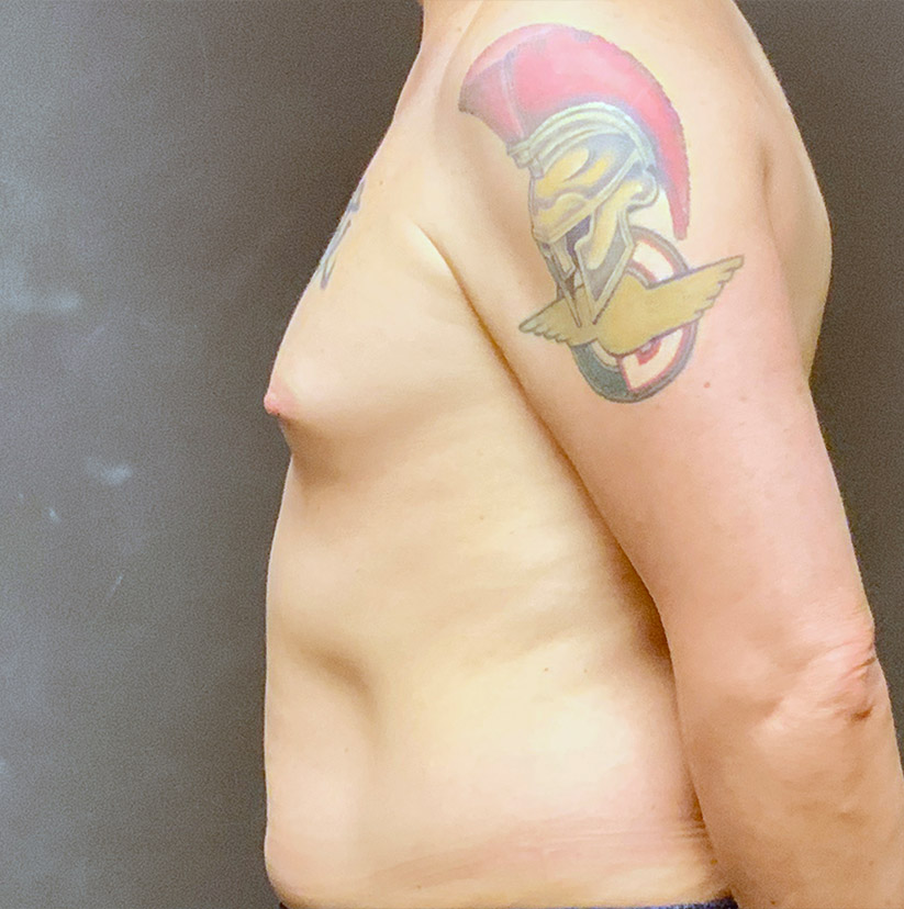 Mtf Breast Augmentation 03