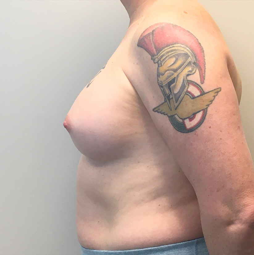 Mtf Breast Augmentation 03