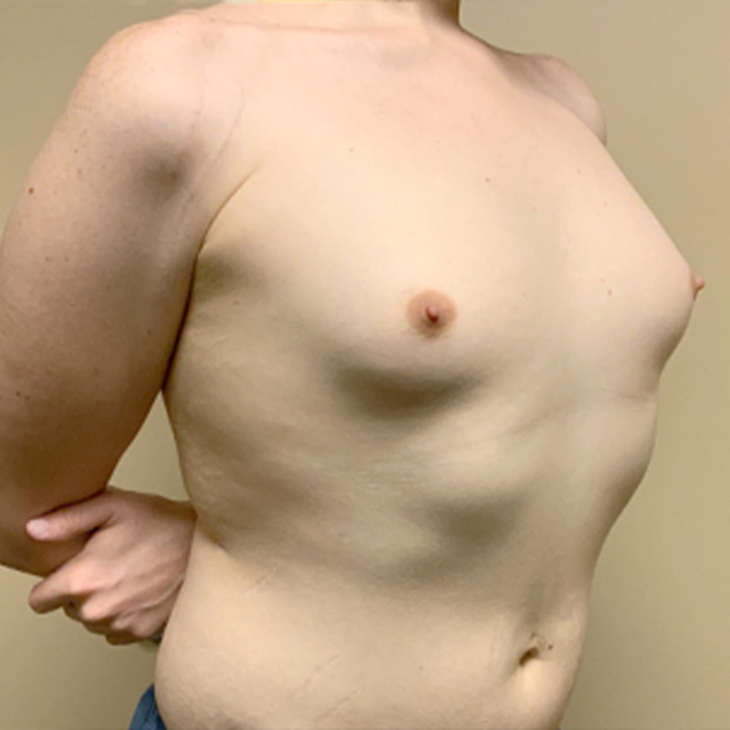 Mtf Breast Augmentation 03