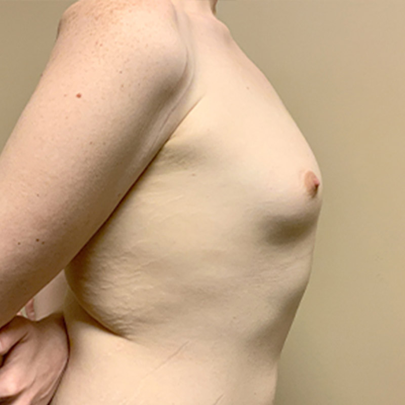 Mtf Breast Augmentation 05