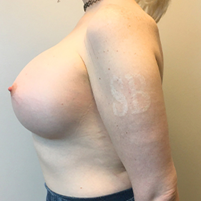 Mtf Breast Augmentation 09