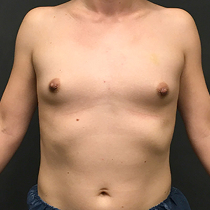Mtf Breast Augmentation 01