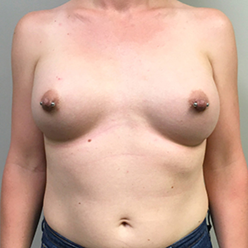 Mtf Breast Augmentation 08