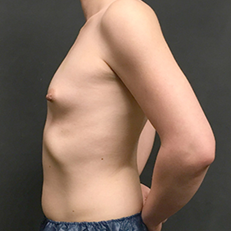 Mtf Breast Augmentation 05