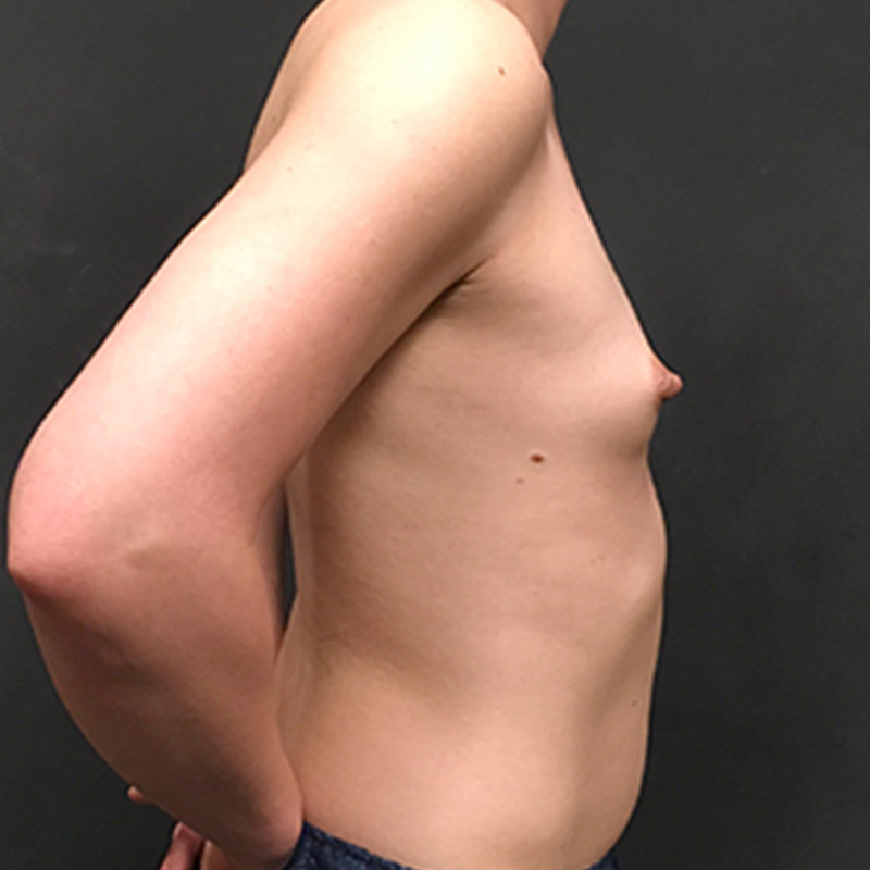 Mtf Breast Augmentation 09