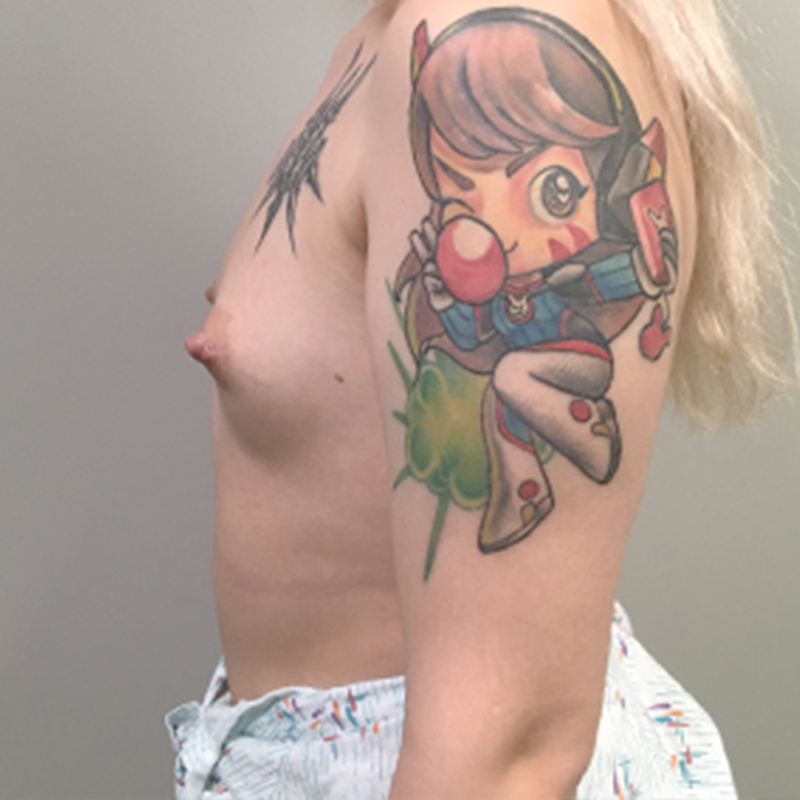 Mtf Breast Augmentation 05