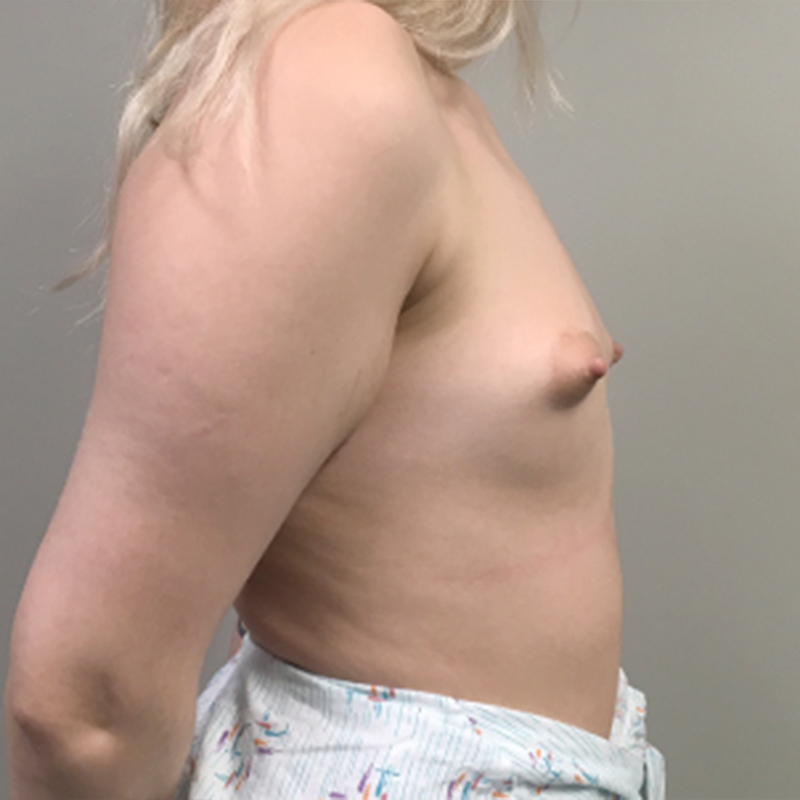 Mtf Breast Augmentation 09