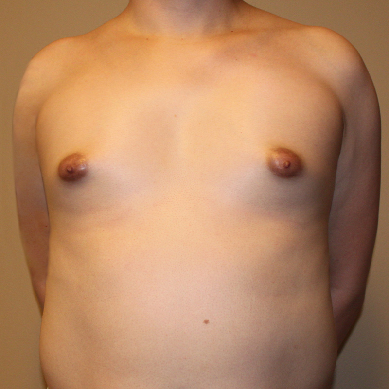 Mtf Breast Augmentation 01