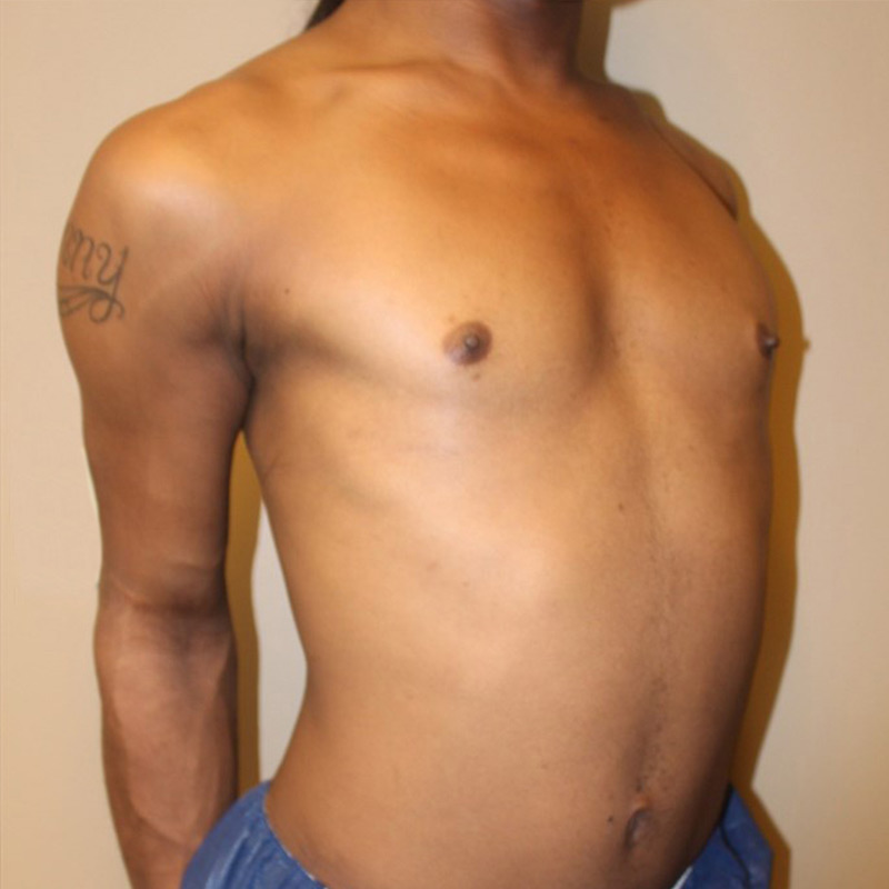 Mtf Breast Augmentation 03