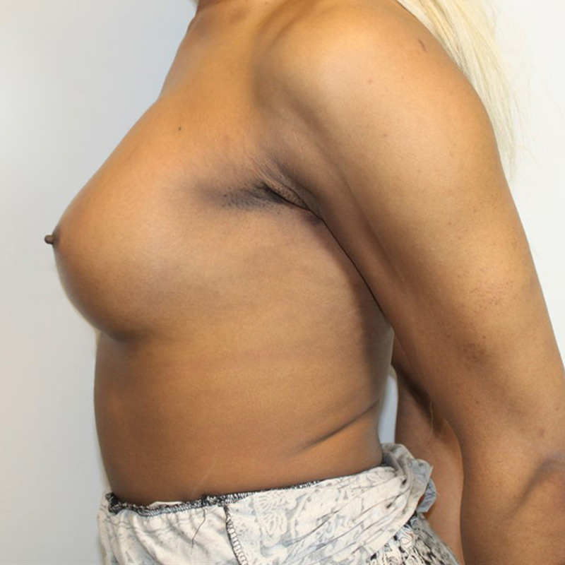 Mtf Breast Augmentation 09