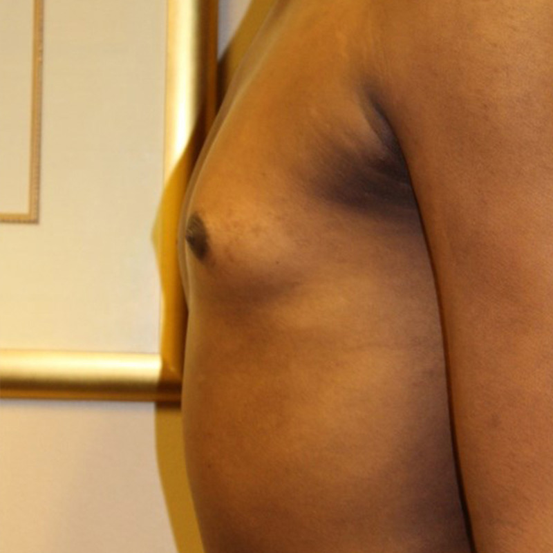 Mtf Breast Augmentation 09