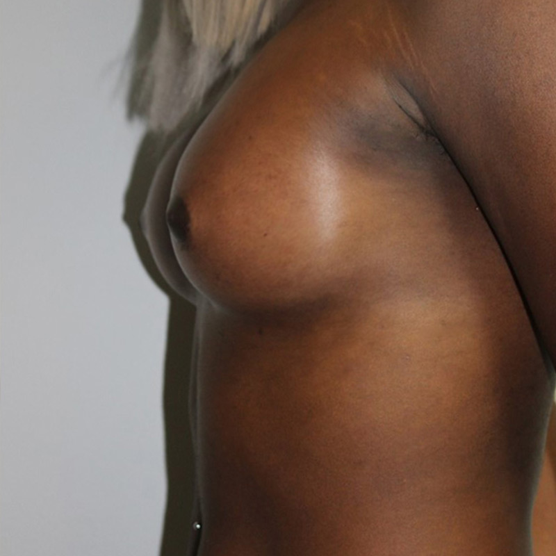 Mtf Breast Augmentation 09