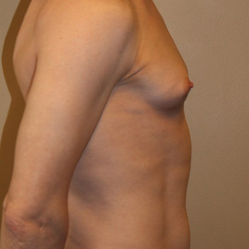 Mtf Breast Augmentation 05