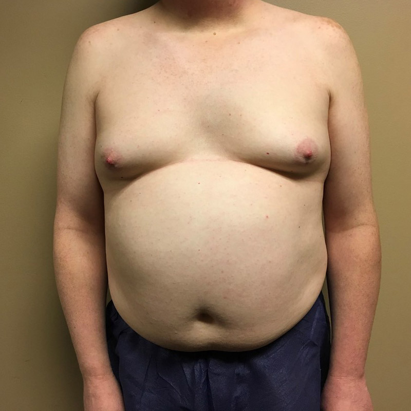 Mtf Breast Augmentation 01