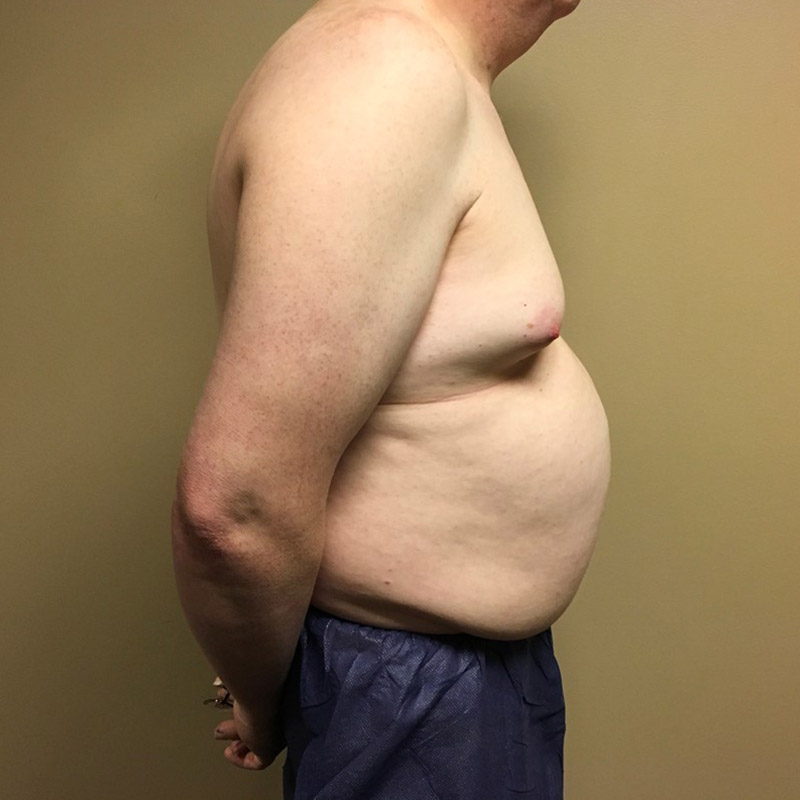 Mtf Breast Augmentation 05