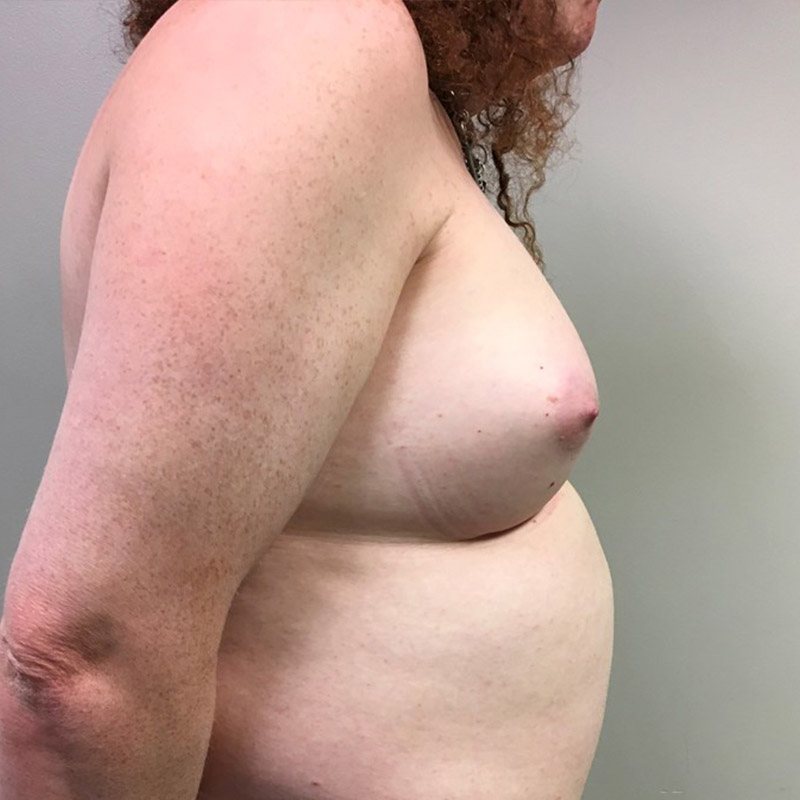 Mtf Breast Augmentation 05