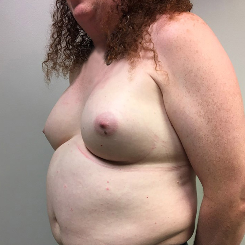 Mtf Breast Augmentation 07
