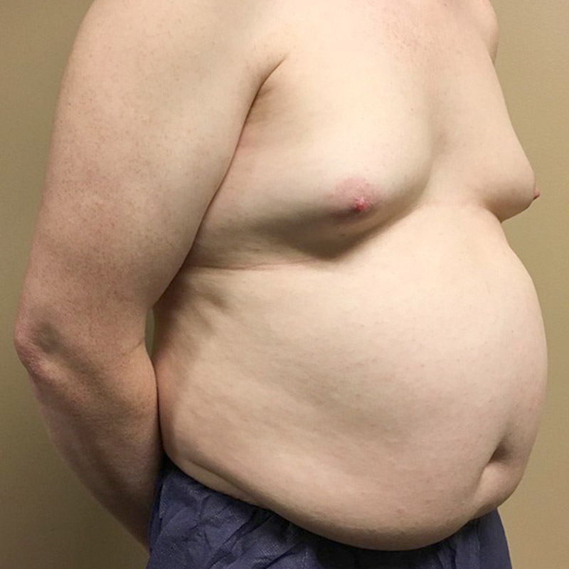 Mtf Breast Augmentation 09