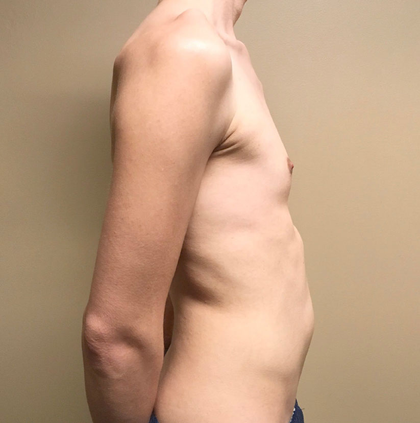 Mtf Breast Augmentation 05