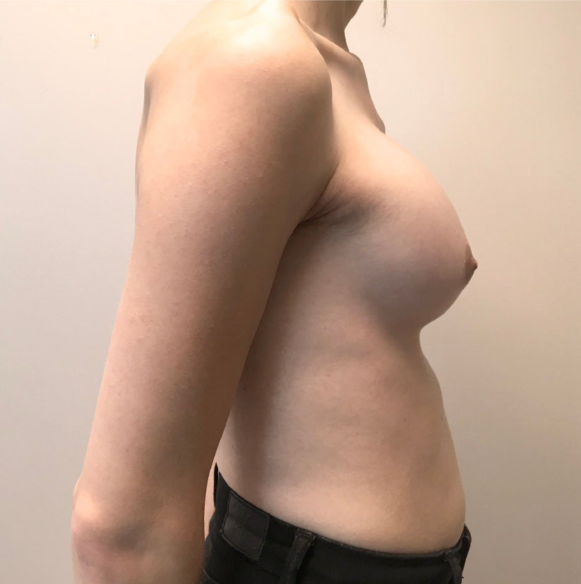 Mtf Breast Augmentation 05
