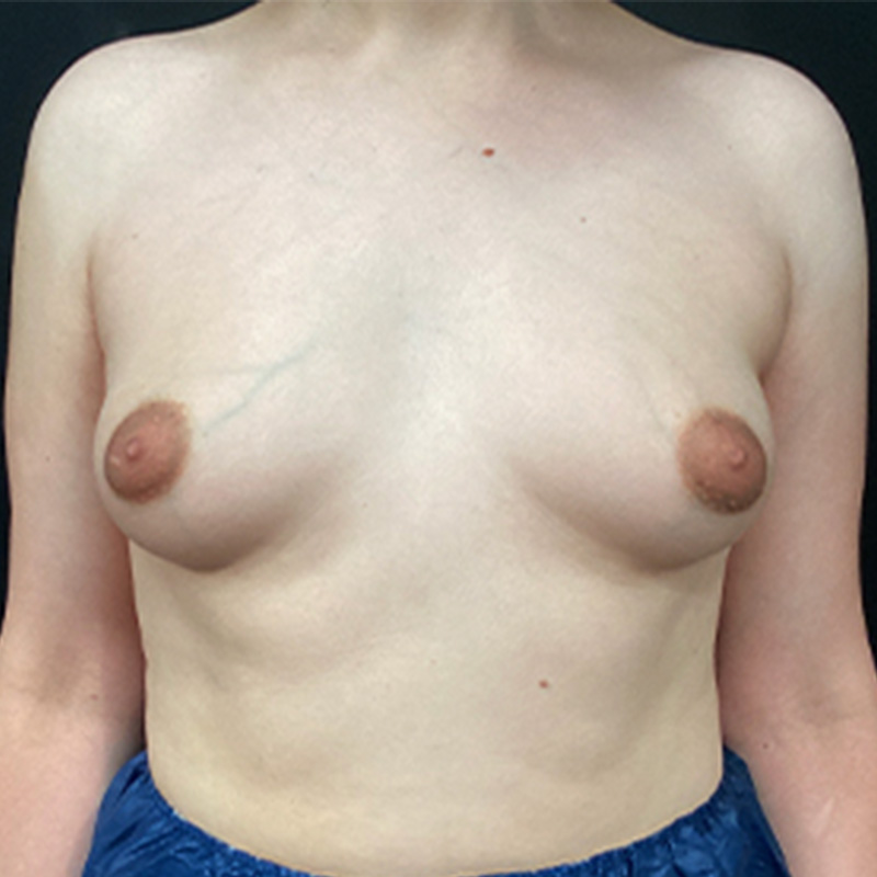 Mtf Breast Augmentation 01