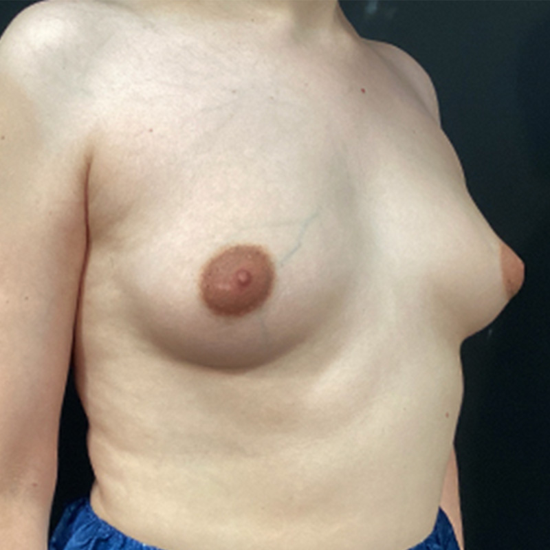 Mtf Breast Augmentation 03