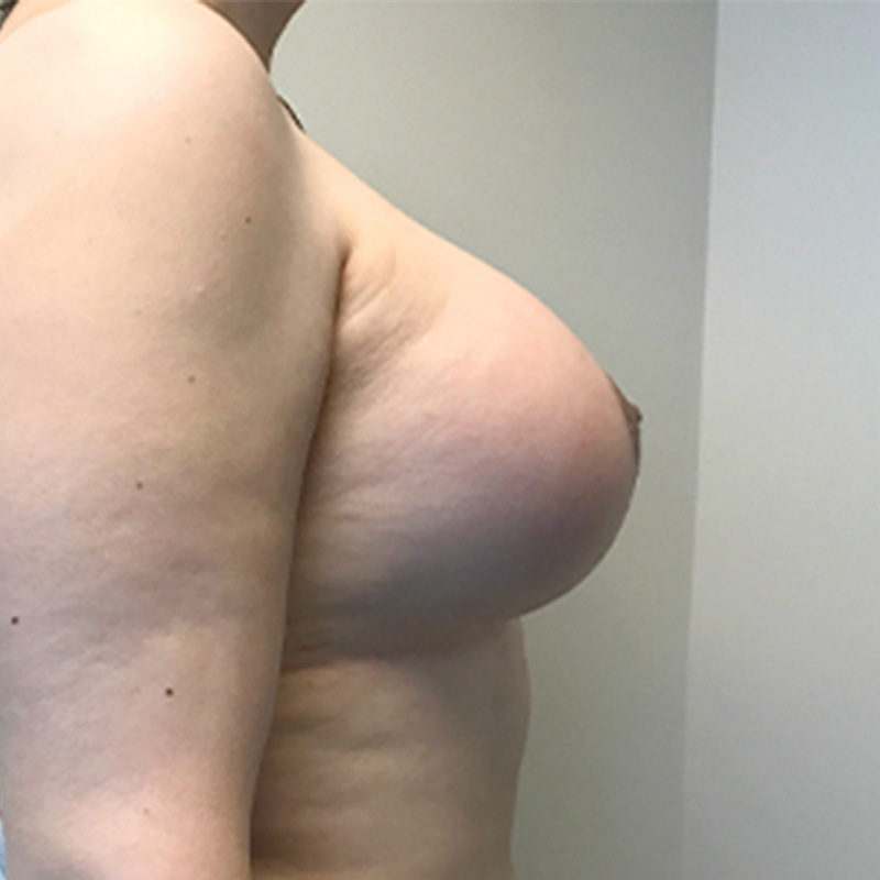Mtf Breast Augmentation 05