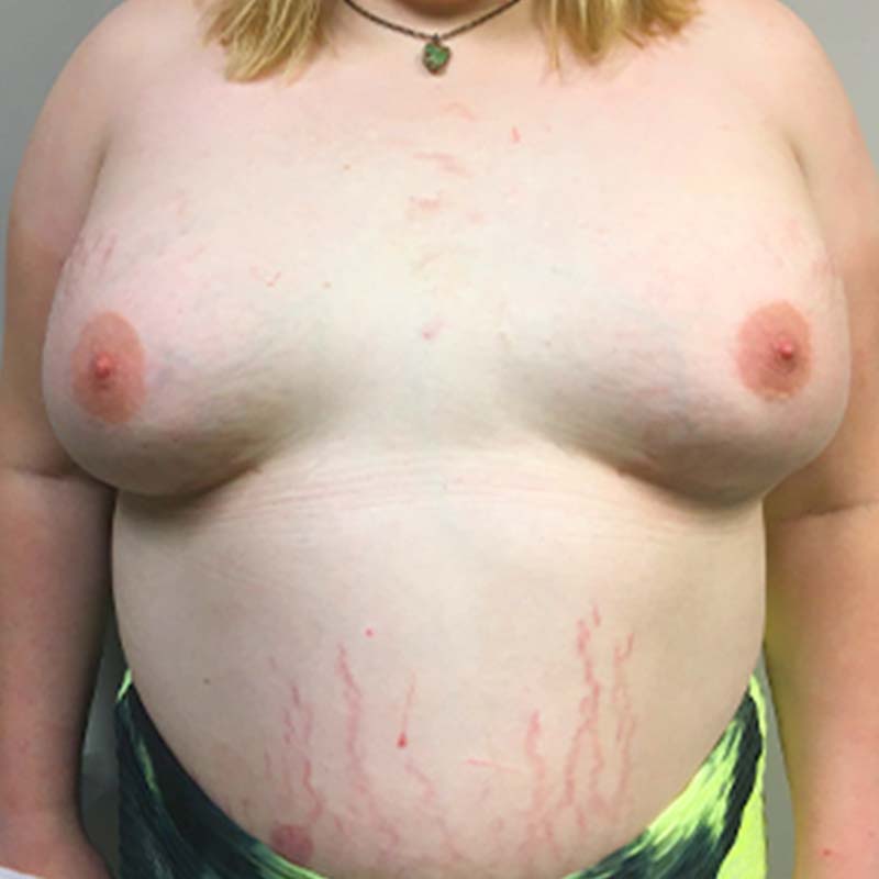 Mtf Breast Augmentation 19