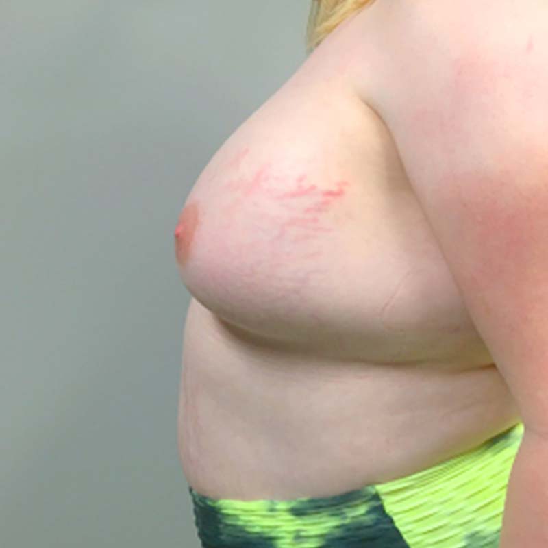 Mtf Breast Augmentation 05