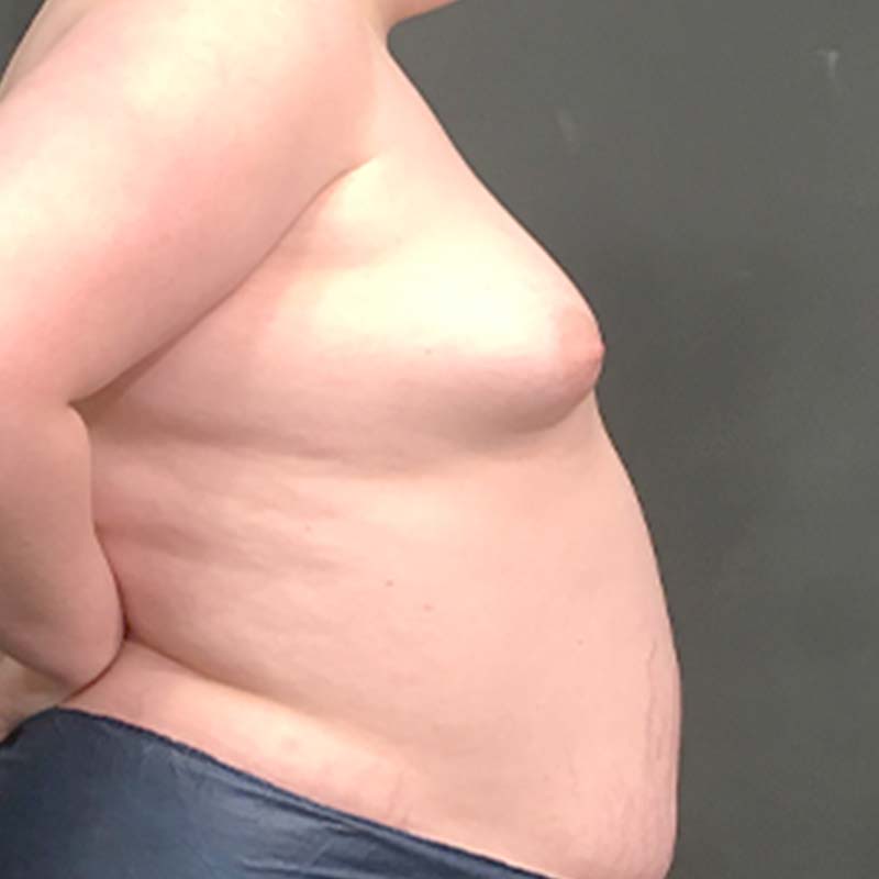 Mtf Breast Augmentation 09