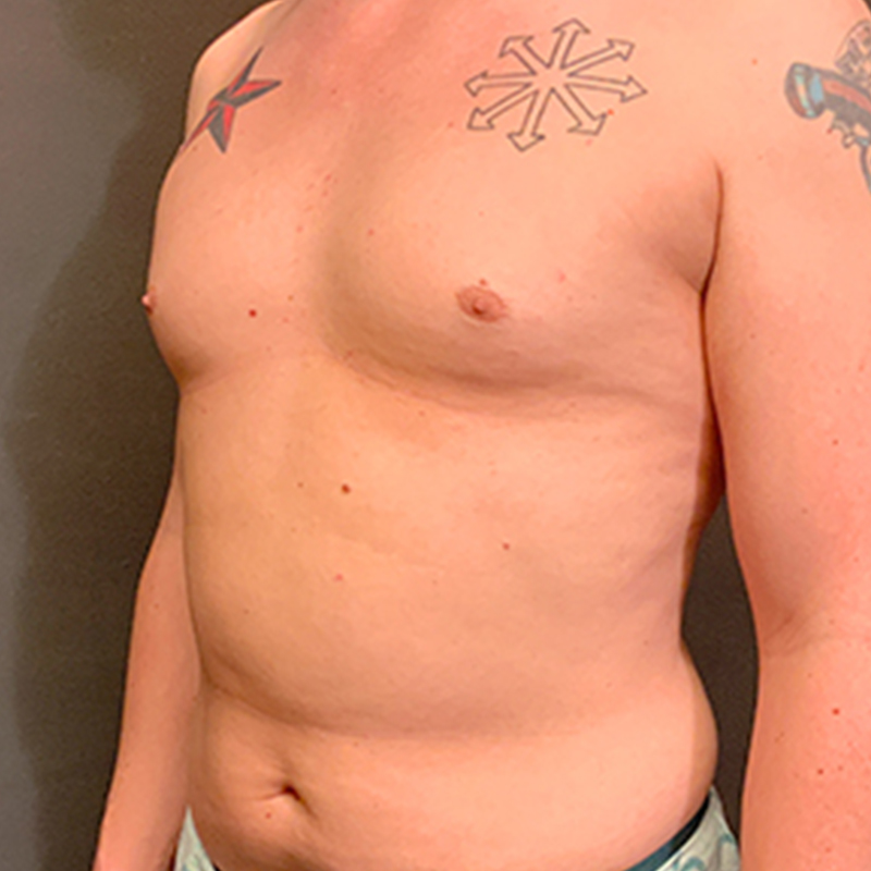 Mtf Breast Augmentation 03