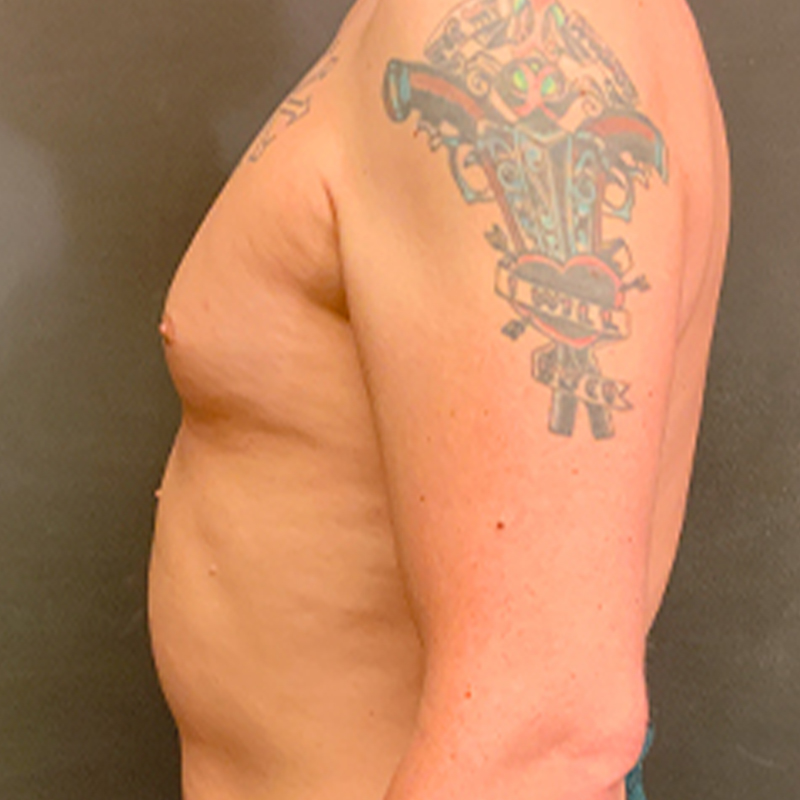 Mtf Breast Augmentation 05